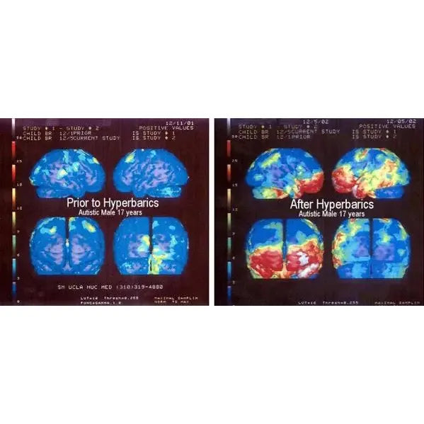 Hyperbaric Hard Shell Oxygen Chamber 36″D 1.6 ATA
