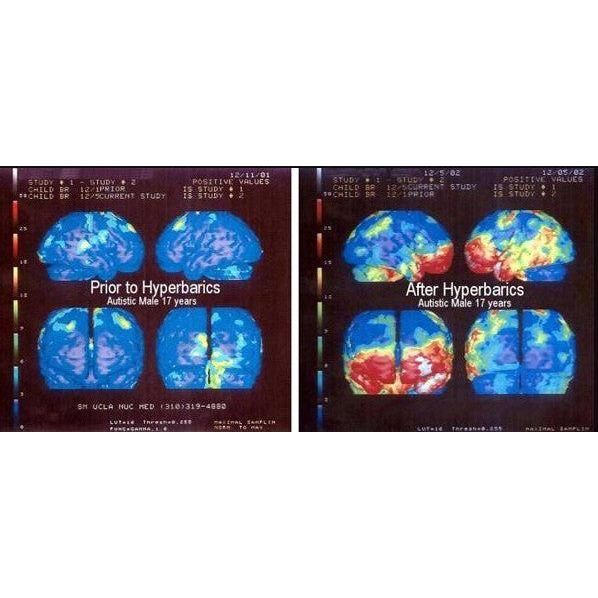 Oxygen Health Systems Hyperbaric Chamber Hardshell 1.5 ATA 30 inch